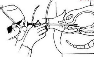 經尿道膀胱腫瘤電切術