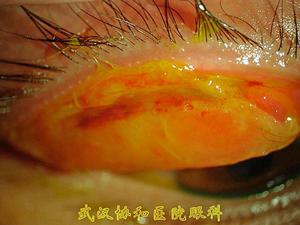 急性眼結膜炎