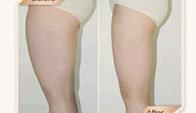 大腿吸脂前後對比