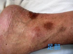 病態竇房結綜合徵