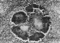 頜面部放線菌病 頜面部放線菌病