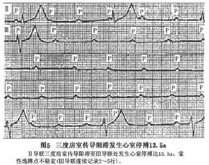 完全性房室傳導阻滯