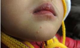 新華醫院誤用藥事件 新華醫院誤用藥事件