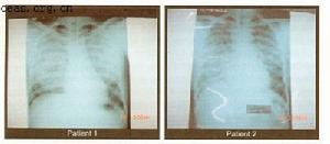 （圖）被尼帕病毒感染的兩個病人的胸部X光線照片