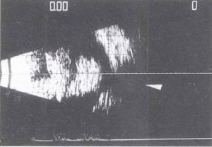 眼內轉移性腫瘤 眼內轉移性腫瘤
