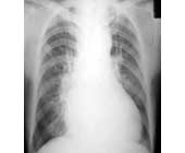 右心造影 右心造影