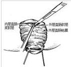 直腸脫垂經會陰切除術