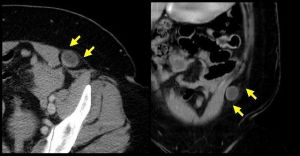 半月線疝 半月線疝