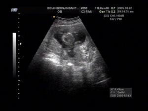 閉經溢乳綜合徵