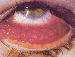 成人包涵體性結膜炎 成人包涵體性結膜炎