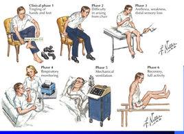 吉蘭巴雷綜合徵 吉蘭巴雷綜合徵