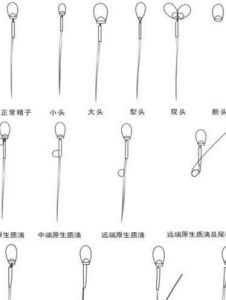 畸形精子症 畸形精子症