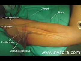 臂叢神經阻滯麻醉 臂叢神經阻滯麻醉