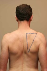 翼狀肩胛 翼狀肩胛