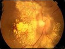 中心暗點或弓形暗點 中心暗點或弓形暗點