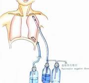 示意圖7:安置胸骨後引流管