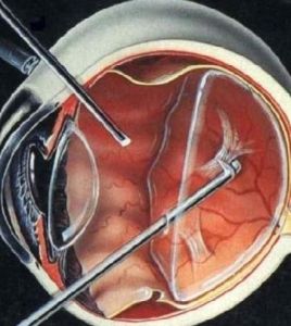 晶狀體渾濁 晶狀體渾濁