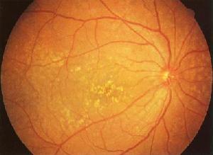 老年性黃斑變性