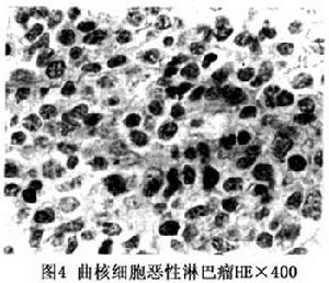 眼眶非霍奇金惡性淋巴腫瘤