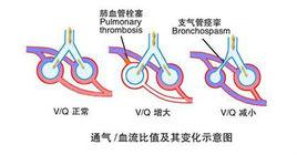 通氣血流比例 通氣血流比例