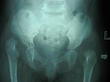 發育性髖關節發育不良