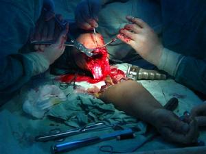 完全離斷 完全離斷