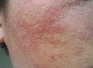 溢脂性皮炎 溢脂性皮炎