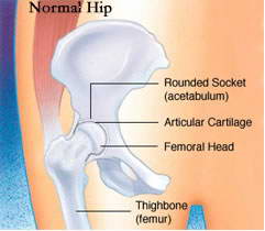 髖關節中心脫位