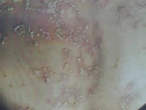 膿包性銀屑病 膿包性銀屑病