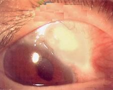 原發性急性閉角型青光眼