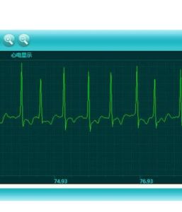 左室高電壓 左室高電壓