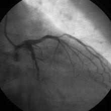 左前分支傳導阻滯（圖）前壁心肌梗死