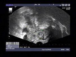 後穹窿積液 後穹窿積液