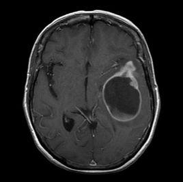 多形性膠質母細胞瘤 多形性膠質母細胞瘤