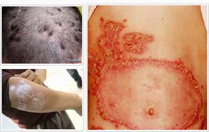 自血回輸免疫療法