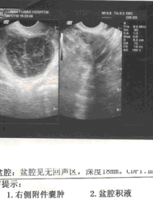 未破裂卵泡黃素化綜合徵 未破裂卵泡黃素化綜合徵