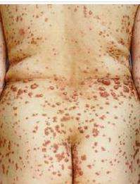 泛發性扁平黃瘤 泛發性扁平黃瘤