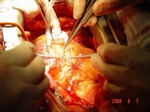 陳舊性心肌梗死 陳舊性心肌梗死