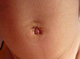 臍窩內有櫻紅色息肉樣物