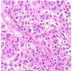 漿細胞瘤