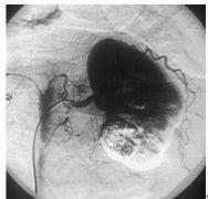 獨腎綜合徵 獨腎綜合徵