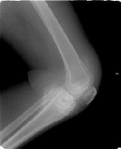 關節滑膜炎 關節滑膜炎