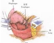 示意圖5:將膈肌腳兩緣進行間斷縫合