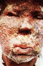 利什曼氏原蟲病 利什曼氏原蟲病