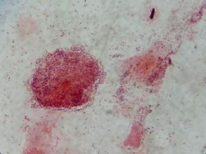 嗜血細胞綜合徵