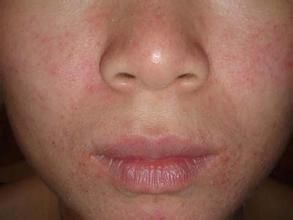 面部脂溢性皮炎 面部脂溢性皮炎