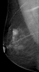 乳腺Ⅹ線攝影 乳腺Ⅹ線攝影