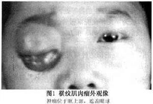 眼眶纖維肉瘤