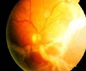 增生性玻璃體視網膜病變