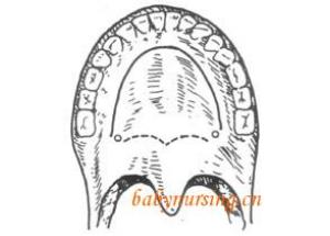 先天性後鼻孔閉鎖